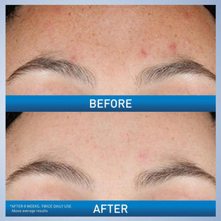 CeraVe - Sérum con retinol para la textura de la piel y las marcas del acné; refina los poros, rejuvenece, iluminador, con retinol y niacinamida, sin fragancia, sin parabenos, no comedogénico, 1 onza